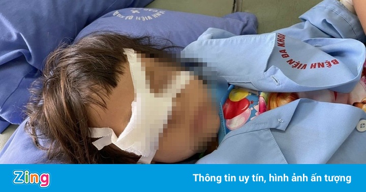 Bé gái bị vỡ nhãn cầu do cây chọc vào mắt Bé gái bị vỡ nhãn cầu do cây chọc vào mắt