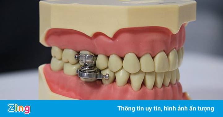 Khóa răng giúp giảm cân Khóa răng giúp giảm cân
