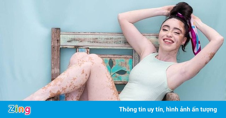 Cô gái mắc chứng bạch biến trở thành mẫu ảnh nổi tiếng