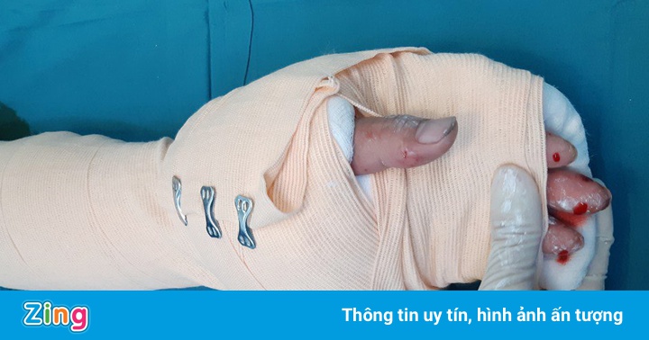 Nối thành công bàn tay đứt lìa cho thanh niên ở Cà Mau