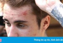 Justin Bieber: ‘Tôi bị bệnh ảnh hưởng tới não và da’