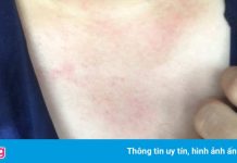 Nhiều người ở Hải Phòng bị mẩn ngứa khi tắm nước sạch