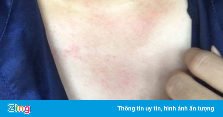 Nhiều người ở Hải Phòng bị mẩn ngứa khi tắm nước sạch