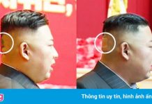Miếng băng dán y tế trên đầu ông Kim Jong Un gây chú ý
