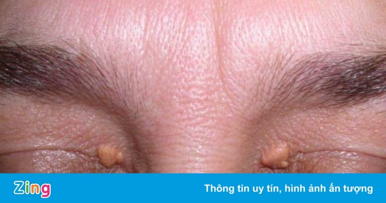 Bất thường trên mắt cảnh báo bạn đang thừa cholesterol