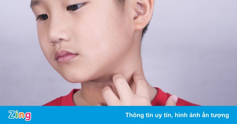 Dấu hiệu cảnh báo trẻ bị dị ứng thực phẩm