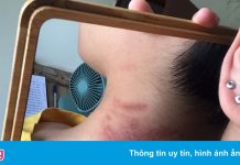 Cư dân ở TP.HCM bị phồng rộp, đau rát da vì kiến ba khoang
