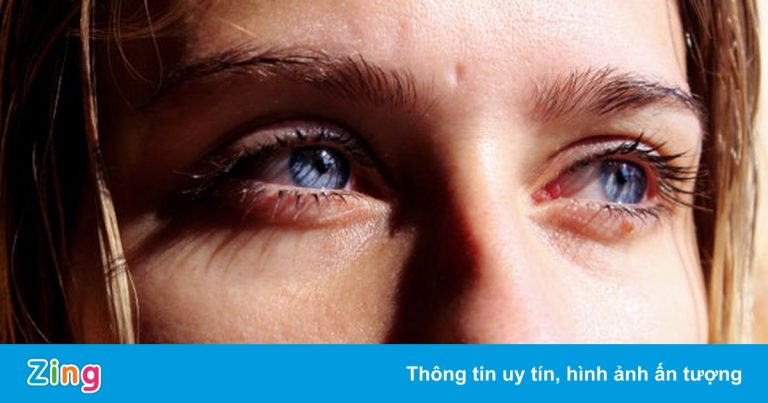 Triệu chứng lạ ở người mắc Covid-19 Triệu chứng lạ ở người mắc Covid-19