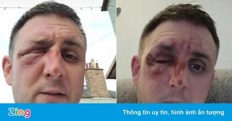 Bỏng mặt vì nấu ăn theo hướng dẫn của TikTok