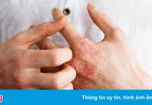 Căn bệnh về da khiến người mắc phải chung sống suốt đời