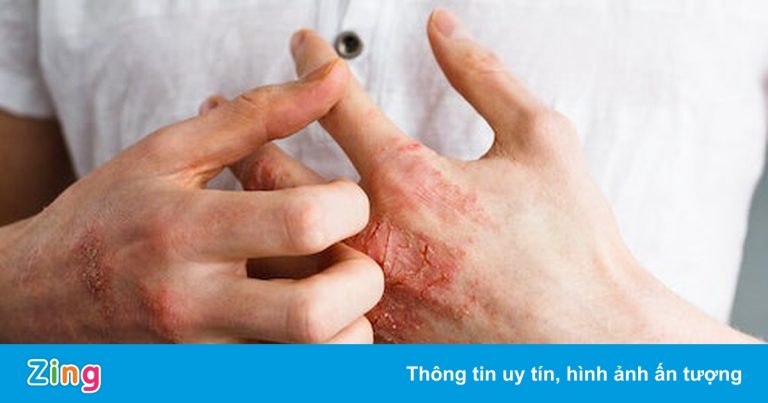 Căn bệnh về da khiến người mắc phải chung sống suốt đời