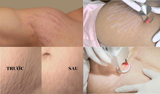 Công nghệ điều trị rạn da bằng laser chỉ có tại THẨM MỸ VIỆN XUÂN TRƯỜNG