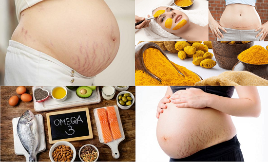 Sự thật về vết rạn da khi mang thai và cách chữa trị hiệu quả tại XUÂN TRƯỜNG Sự thật về vết rạn da khi mang thai và cách chữa trị hiệu quả tại XUÂN TRƯỜNG